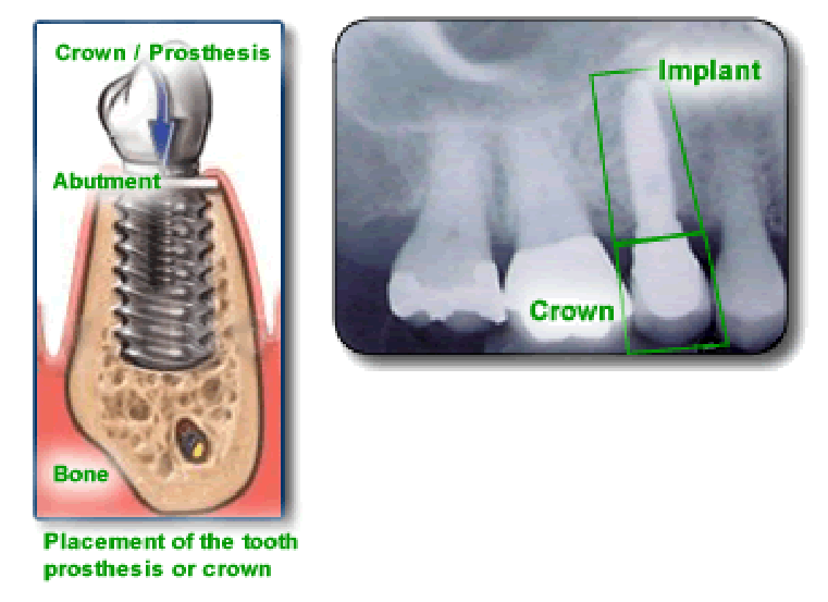Dr. Hogan, Dental Implants, Columbia Periodontist, South Carolina, SC