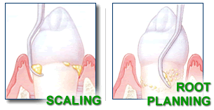 Dr. Hogan, Scaling and Root Planning, Columbia Periodontist, South Carolina, SC